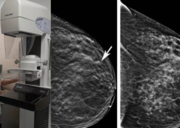 La Arrixaca reduce de más de 40 días a menos de una hora el diagnóstico completo ante una sospecha de cáncer de mama